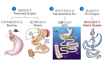 外科手术能根治糖尿病吗？